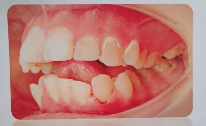 Recuperando mi Voz y mi Sonrisa - Mi misión es recaudar los fondos necesarios para cubrir mi tratamiento de parálisis de lengua y orto... | Recaudación de fondos en Coral